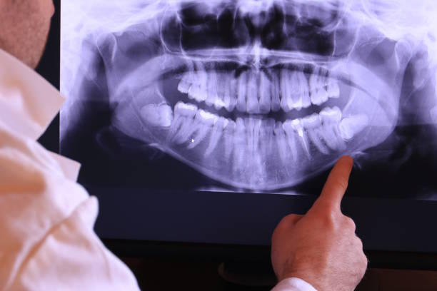 Best Emergency Wisdom Teeth Removal in Monroeville, IN