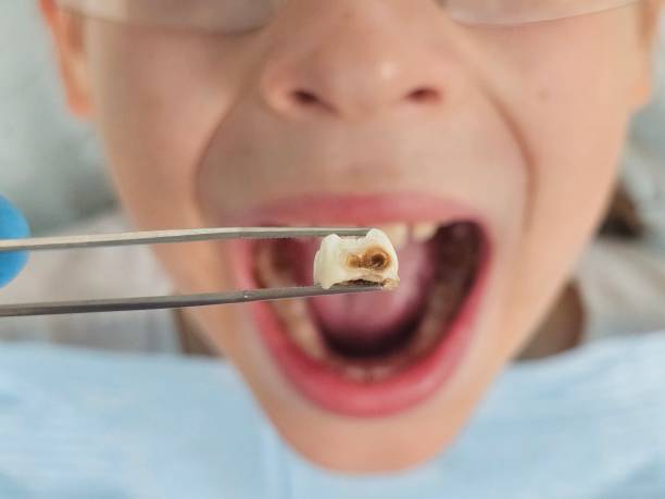 Best Emergency Tooth Extraction in Monroeville, IN
