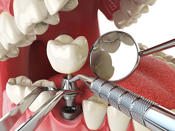 Best Emergency Dental Care for Broken or Chipped Teeth in Monroeville, IN